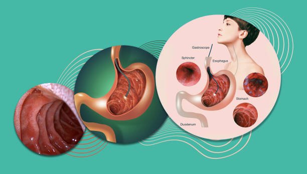 Gastroshiza: Complete Overview, Symptoms, Causes, and Management