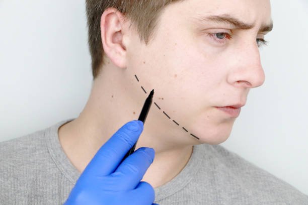 Chin Implant Scar: Everything You Need to Know About Healing and Scar Prevention